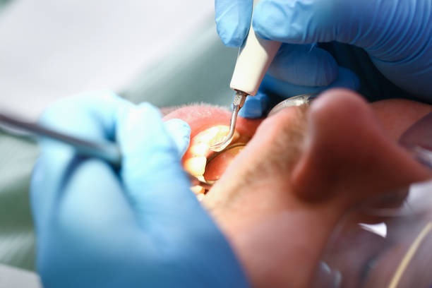 Best Emergency Dentist for Knocked-Out Tooth in Burke Centre, VA