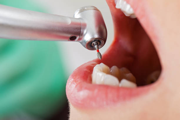 Best Emergency Dentist for Lost Fillings or Crowns in Burke Centre, VA